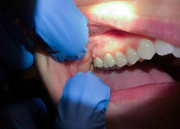 Best Emergency Tooth Extraction in Washington, NC